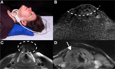 Improvements in High Resolution Laryngeal Magnetic Resonance Imaging for Preoperative Transoral Laser Microsurgery and Radiotherapy Considerations in Early Lesions